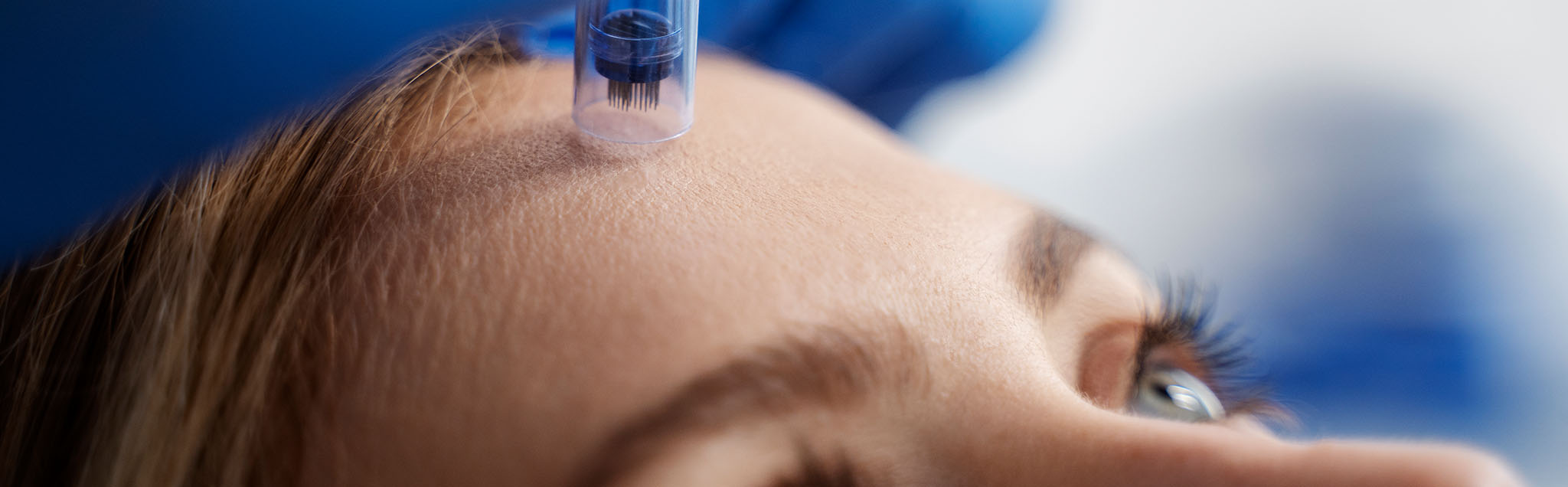 microneedling promd bel air featured