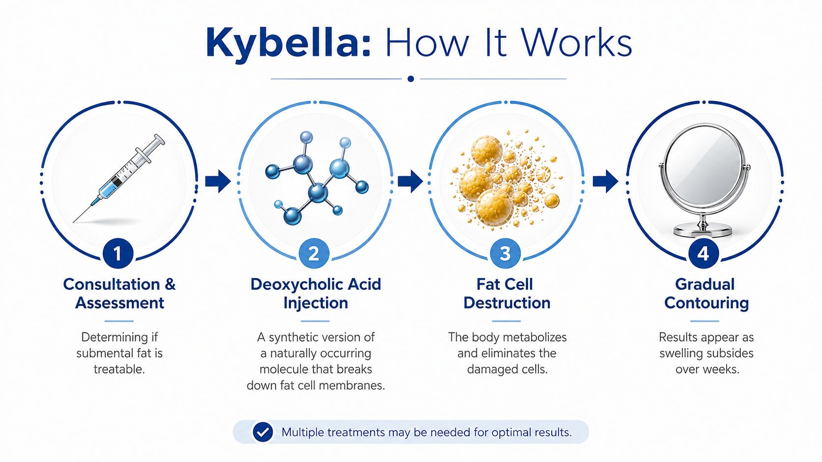 An infographic detailing the four-step Kybella treatment process for reducing submental chin and neck fat.