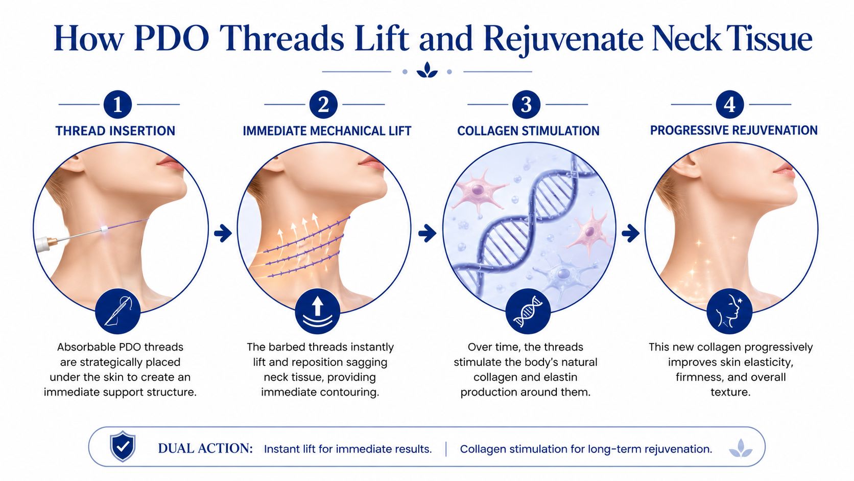 A four-step infographic showing how PDO threads provide a non-surgical lift and collagen stimulation for neck skin.