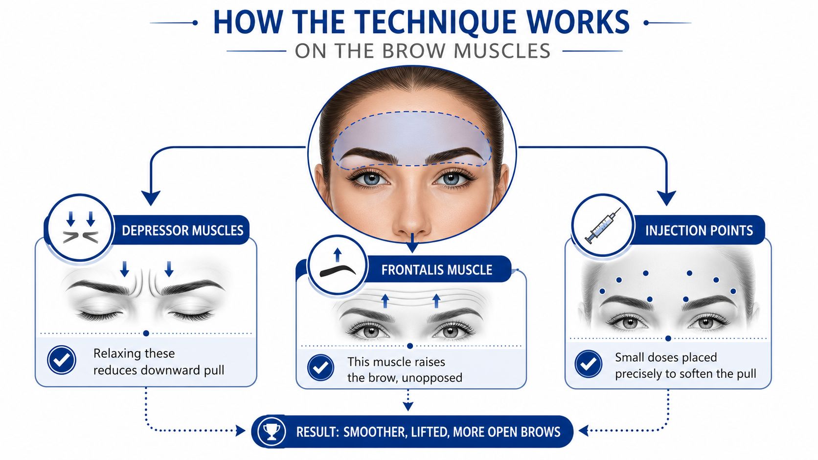 A medical infographic showing how the botox brow lift technique works by relaxing specific facial muscles.