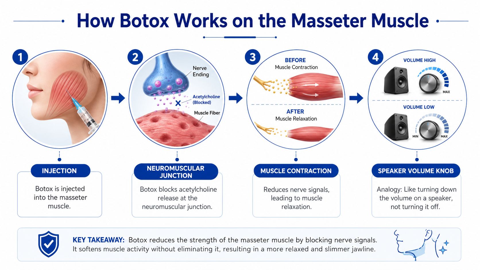A four-step infographic explaining how Botox injections work to relax the masseter muscle and slim the jawline.