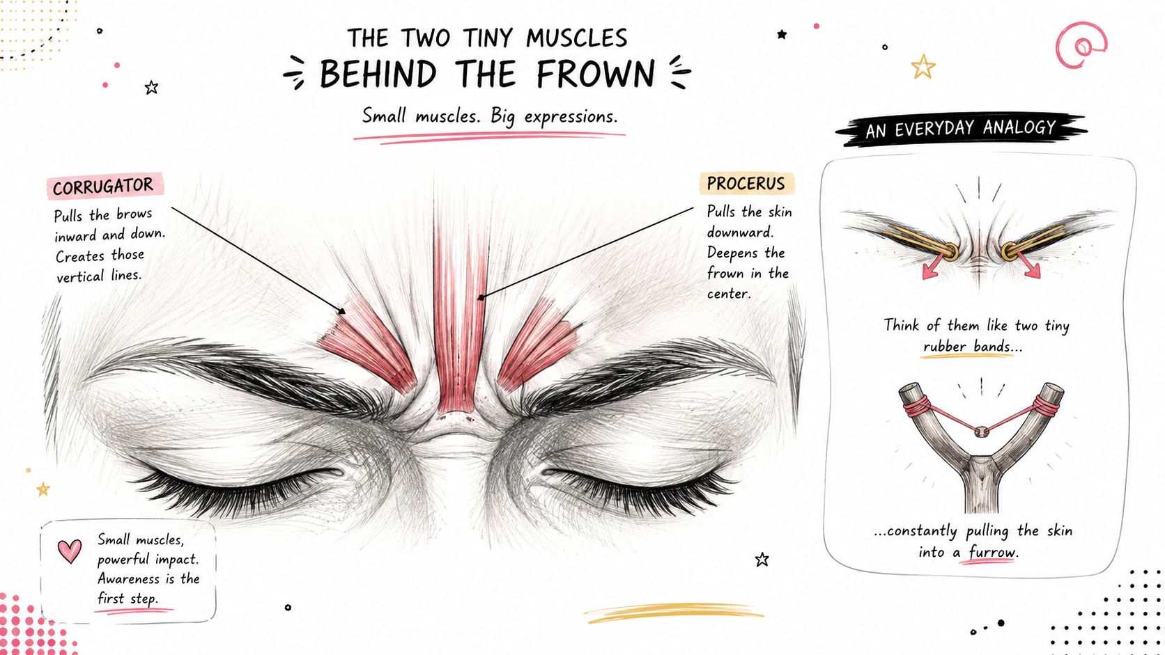 A detailed diagram illustrating the corrugator and procerus muscles responsible for facial frowning and glabellar lines.